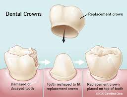 Illustration of process for Dental Crowns application, White Lake, MI