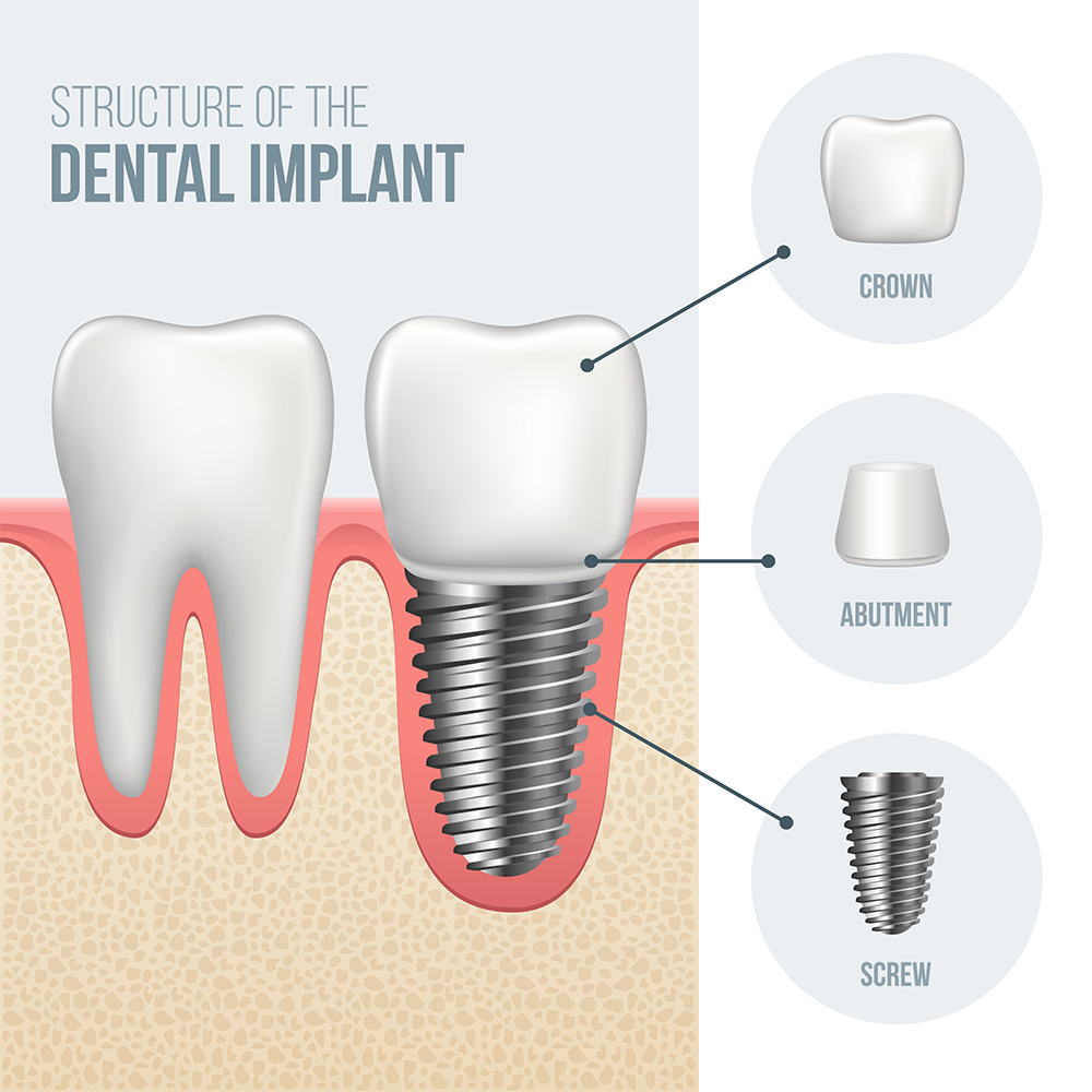 Illustration of anatomy of Dental Implants, White Lake, MI