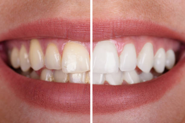 Photograph of smile showing before and after Teeth Whitening, White Lake, MI